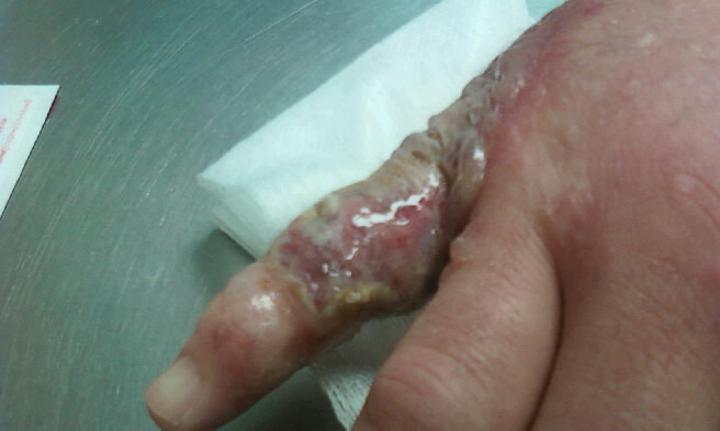 Paper Cut like wounds appearing on finger - Dermatology ...